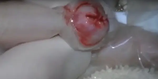 Why Does Tumor Burst